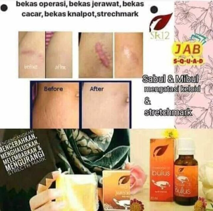 Obat Keloid Menonjol Tahunan Ampuh Obat Keloid Daging Tumbuh Penghilang