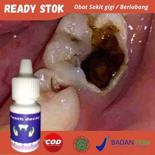 TOOTH DECAY ( PENUMBUH GIGI, PENGHILANG KARANG GIGI, GIGI KROPOS ) 100