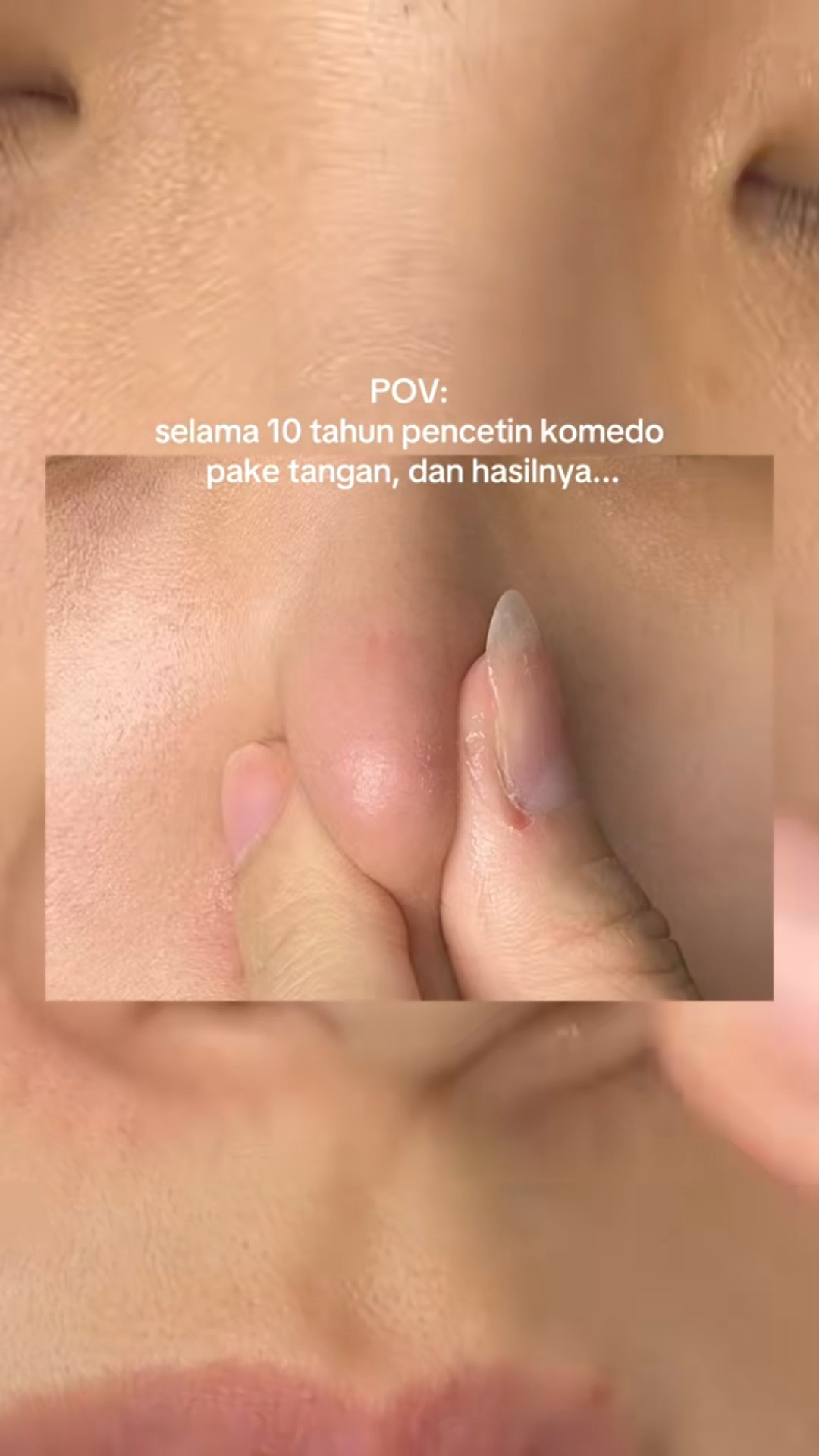 FOCALSKIN Step Removes Blackhead Nose Patch Masker Komedo Stiker