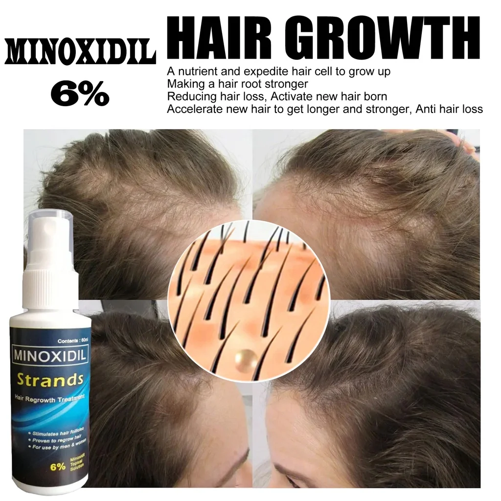 Minoxidil Strands 6 Minoxidil Kirkland Minoxidil Topical Solution Hair